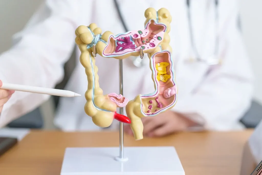 Cancro Colorretal: Como Prevenir e Identificar os Sinais de Alerta