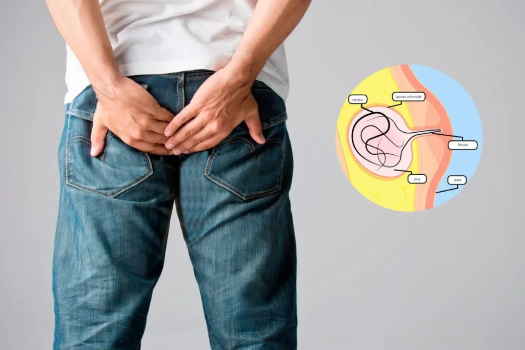 Quisto Pilonidal – Cirurgia a laser minimamente invasiva